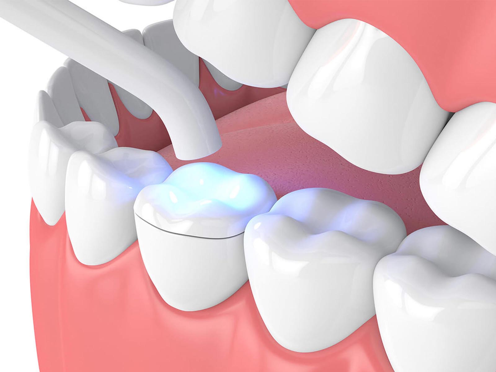 Dental Inlays and Onlays Services